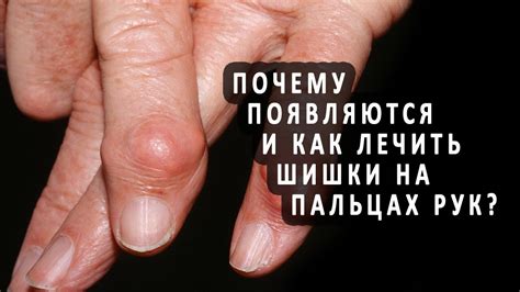 Почему возникают шишки на пальцах?