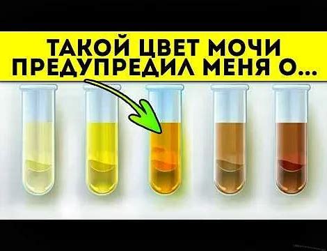 Почему моча может иметь яркий желтый цвет: основные причины и связанные заболевания