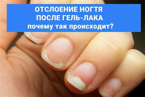 Почему ноготь отслоился после гель лака?