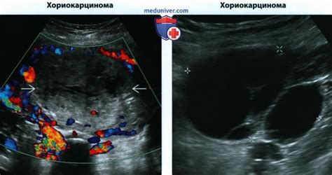 Почему плодное яйцо может быть деформировано?