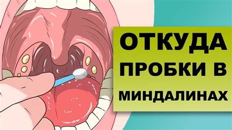 Почему появляется гнойный налет на миндалинах?