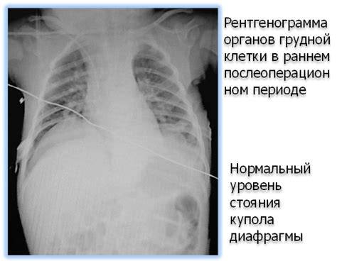 Почему релаксация диафрагмы слева важна для дыхательной системы?