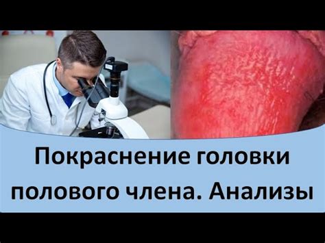 Почему шишка на пенисе у мужчин может быть опасной?