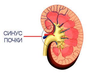 Почечный синус разрыхлен