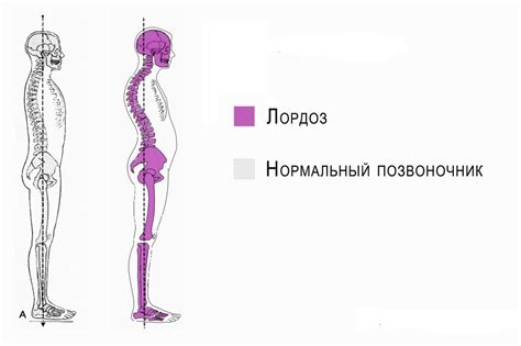 Поясничный лордоз: причины и восстановление естественной кривизны