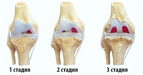 Правосторонний гонартроз 1 степени коленного сустава