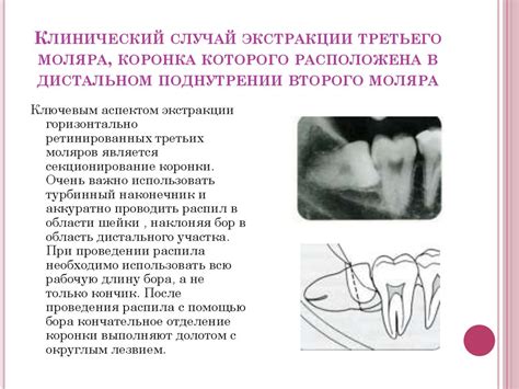 Предпосылки для возникновения мечты об экстракции зуба в иллюзорном мире