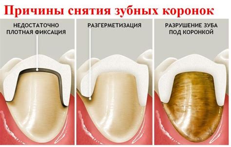 Предупреждение о возможных потерях: под сны о выпавшем зубе без боли