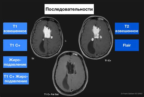 Преимущества МРТ с жироподавлением