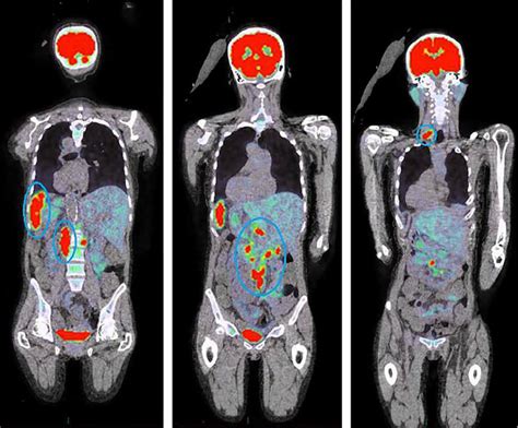 Преимущества ПЭТ/КТ при исследовании всего тела пациента