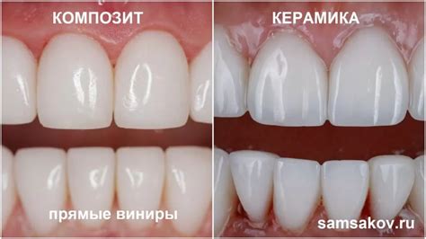 Преимущества и недостатки виниров