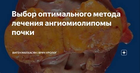 Преимущества и риски различных методов лечения ангиомиолипомы правой почки