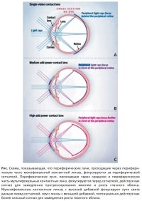 Преимущества мультифокальных контактных линз