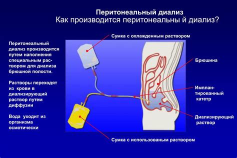 Преимущества перитонеального диализа