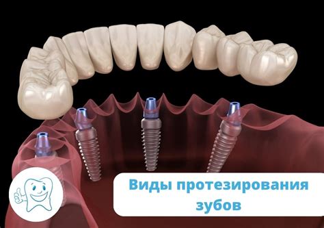 Преимущества рационального протезирования зубов