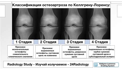 Признаки генерализованного остеоартроза