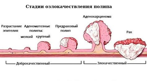 Признаки железистого полипа