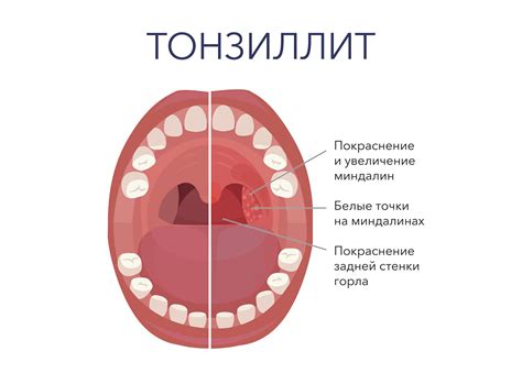 Признаки и симптомы гноя в горле