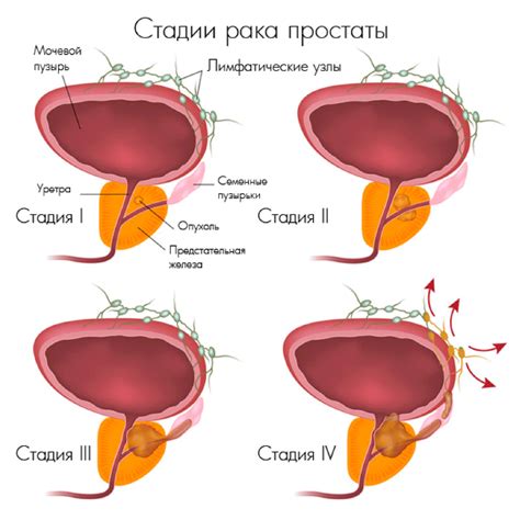 Признаки и симптомы умеренно дифференцированной аденокарциномы простаты