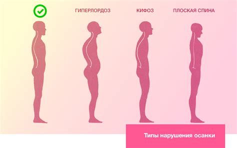 Признаки лордотической осанки