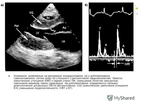 Признаки на эхокардиограмме
