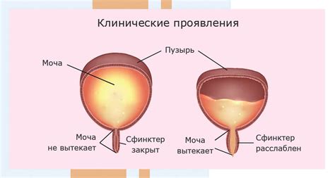 Признаки нейрогенного мочевого пузыря