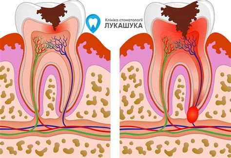 Признаки опухи зуба: симптомы и проявления