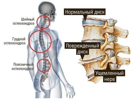 Признаки остеохондроза