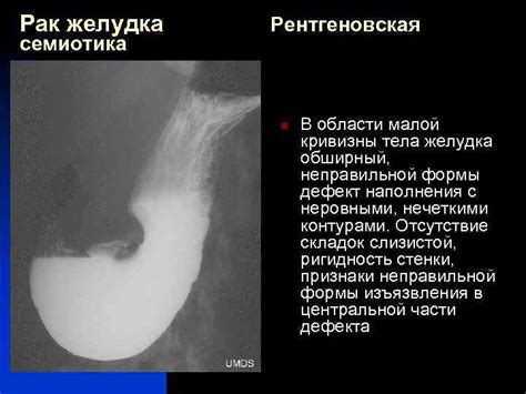 Признаки отсутствия перистальтики желудка