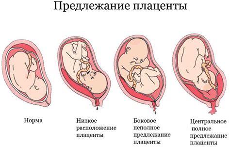 Признаки предлежания ветвистого хориона