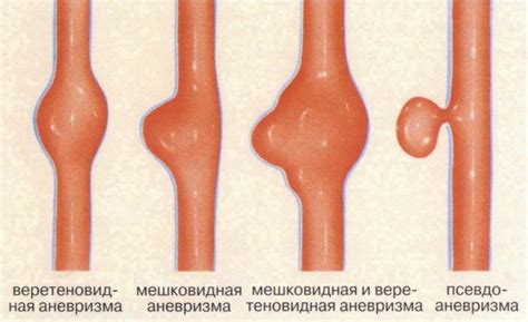 Признаки разрыва аневризмы