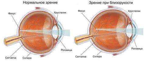 Признаки слабой степени близорукости