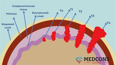 Признаки уротелиальной карциномы high grade: какие симптомы необходимо обратить внимание