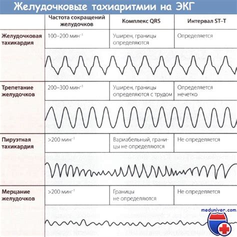 Признаки фибрилляции желудочков