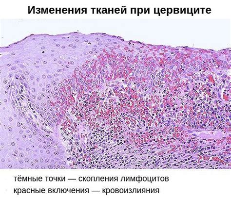 Признаки эндоцервицита