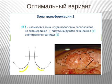 Применение кольпоскопии для оценки низкоатипической ЗТ