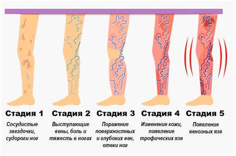 Применение противовоспалительных лекарств