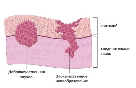 Примеры неинкапсулированных опухолей