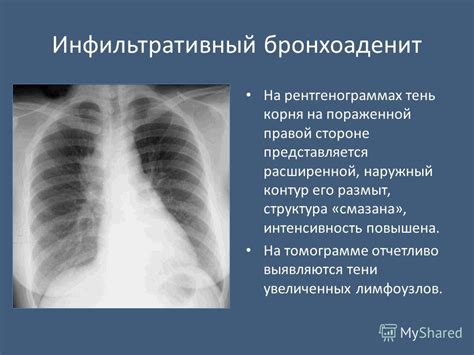 Примеры обнаружения гиподенсных зон на рентгенограммах