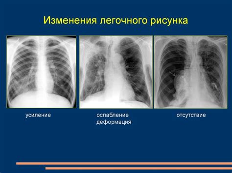 Принципы локального обогащения легочного рисунка