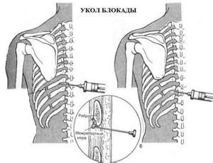 Принципы укола блокады