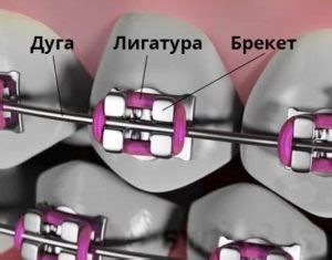 Принцип работы безлигатурных брекетов