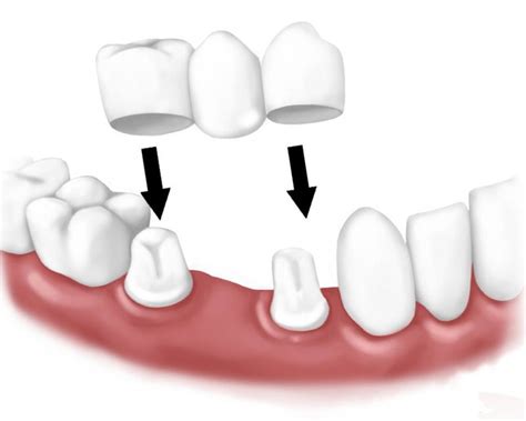 Принцип работы моста для зубов