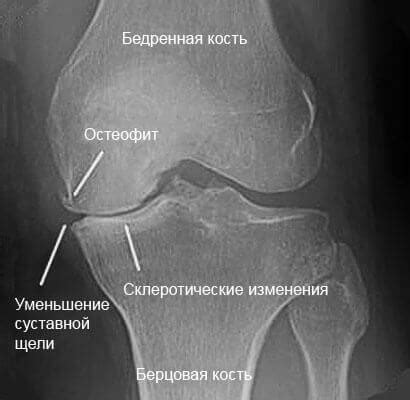 Природные особенности Межмыщелковых возвышений