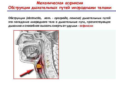 Притоковая обструкция