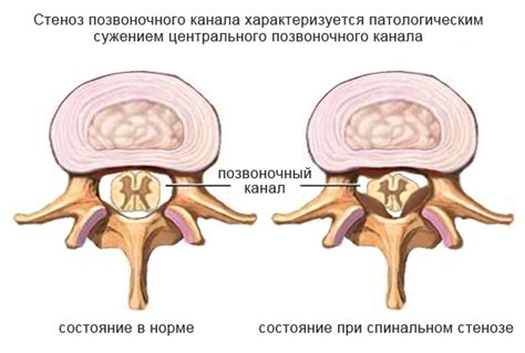 Причины анатомической узости позвоночного канала