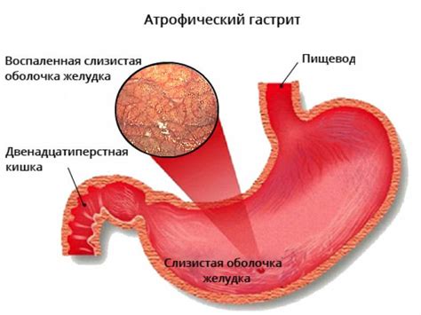 Причины атрофии слизистой кишечника