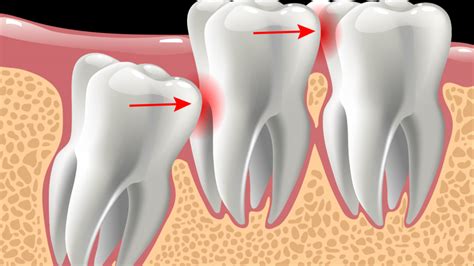 Причины боли зуба мудрости