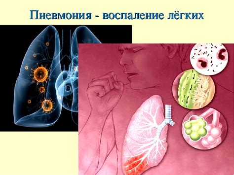 Причины внутрибольничной пневмонии