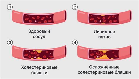 Причины возникновения атеросклероза